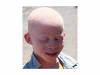 Albinistic boy