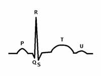 The parts of a QRS complex. Ventricul...