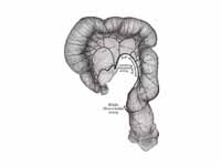 Sigmoid colon and rectum, showing dis...