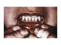Scorbutic gums, a symptom of scurvy